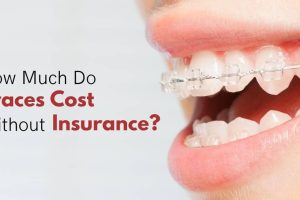 How Much Do Braces Cost Without Insurance?