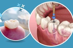 Root Canal Without Insurance