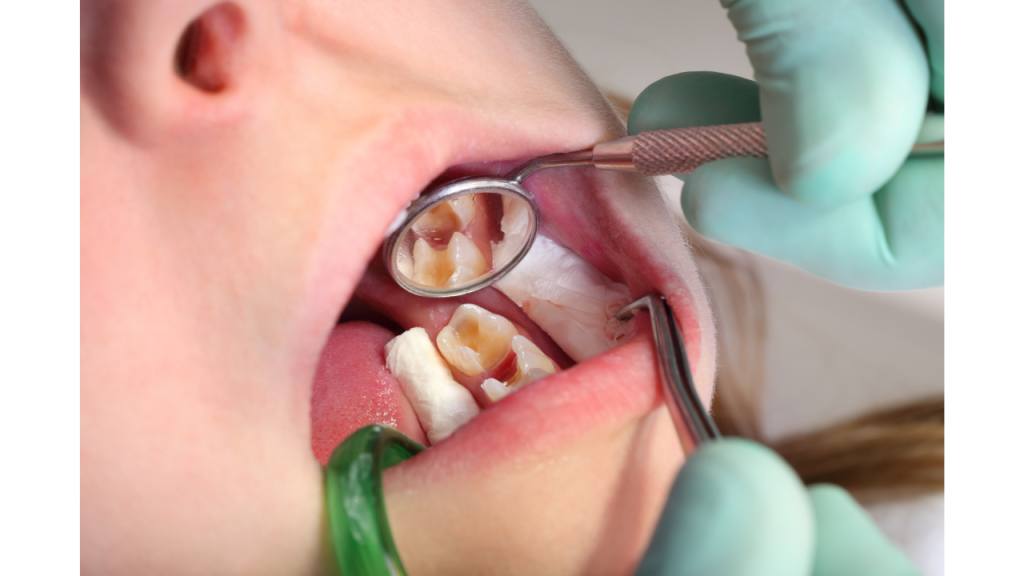 Cost Of Filling A Cavity With Insurance Insurance Noon