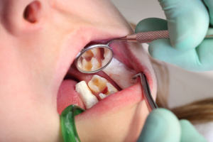 How Much Does It Cost To Fill A Cavity With Insurance