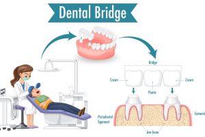 How Much Does A Dental Bridge Cost With Insurance
