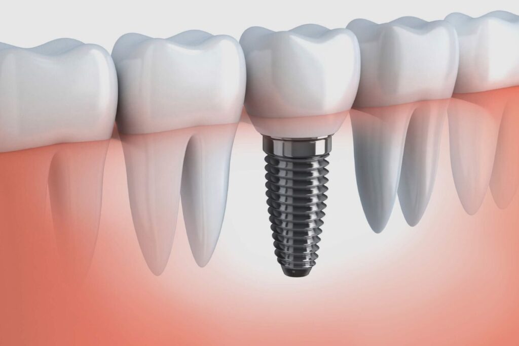 Are Dental Implants Covered By Blue Cross Insurance